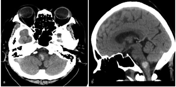 5毫升就可能致命的“脑干出血”到底有多可怕?能治得好吗?能手术吗? 5毫升就可能致命的“脑干出血”到底有多可怕?能治得好吗?能手术吗?