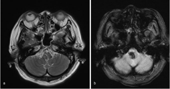 5毫升就可能致命的“脑干出血”到底有多可怕?能治得好吗?能手术吗? 5毫升就可能致命的“脑干出血”到底有多可怕?能治得好吗?能手术吗?