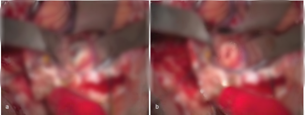 5毫升就可能致命的“脑干出血”到底有多可怕?能治得好吗?能手术吗? 5毫升就可能致命的“脑干出血”到底有多可怕?能治得好吗?能手术吗?