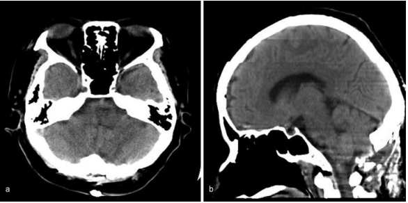 5毫升就可能致命的“脑干出血”到底有多可怕?能治得好吗?能手术吗? 5毫升就可能致命的“脑干出血”到底有多可怕?能治得好吗?能手术吗?