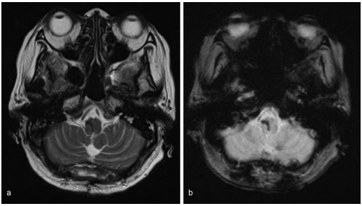 5毫升就可能致命的“脑干出血”到底有多可怕?能治得好吗?能手术吗? 5毫升就可能致命的“脑干出血”到底有多可怕?能治得好吗?能手术吗?