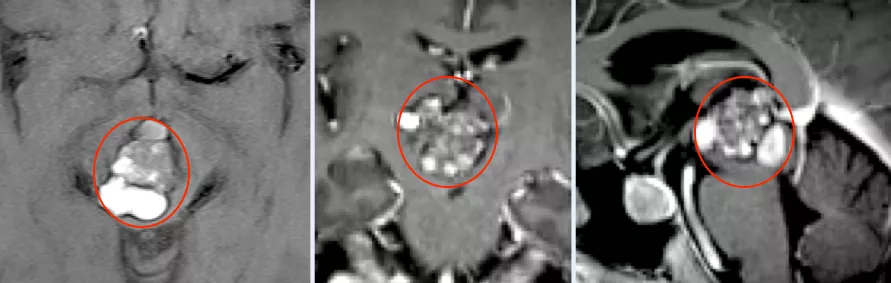 5毫升就可能致命的“脑干出血”到底有多可怕?能治得好吗?能手术吗? 5毫升就可能致命的“脑干出血”到底有多可怕?能治得好吗?能手术吗?