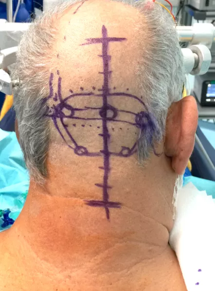 5毫升就可能致命的“脑干出血”到底有多可怕?能治得好吗?能手术吗? 5毫升就可能致命的“脑干出血”到底有多可怕?能治得好吗?能手术吗?