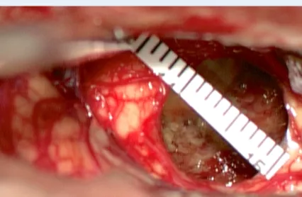 5毫升就可能致命的“脑干出血”到底有多可怕?能治得好吗?能手术吗? 5毫升就可能致命的“脑干出血”到底有多可怕?能治得好吗?能手术吗?