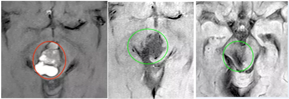 5毫升就可能致命的“脑干出血”到底有多可怕?能治得好吗?能手术吗? 5毫升就可能致命的“脑干出血”到底有多可怕?能治得好吗?能手术吗?