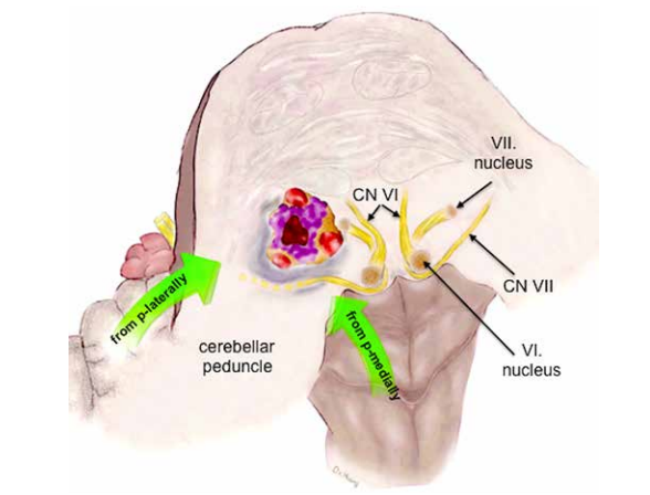 JNS发表德国巴特朗菲教授135例脑干脑桥海绵状血管瘤手术及疗效研究 JNS发表德国巴特朗菲教授135例脑干脑桥海绵状血管瘤手术及疗效研究