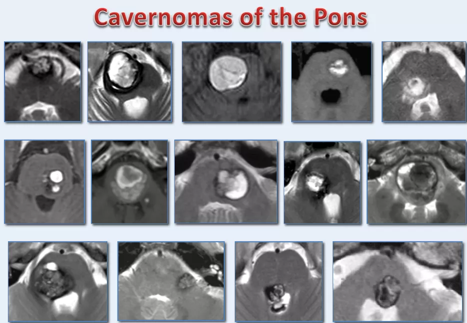 JNS发表德国巴特朗菲教授135例脑干脑桥海绵状血管瘤手术及疗效研究 JNS发表德国巴特朗菲教授135例脑干脑桥海绵状血管瘤手术及疗效研究