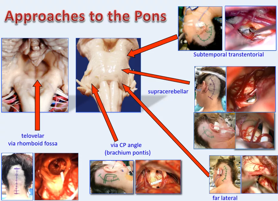 JNS发表德国巴特朗菲教授135例脑干脑桥海绵状血管瘤手术及疗效研究 JNS发表德国巴特朗菲教授135例脑干脑桥海绵状血管瘤手术及疗效研究