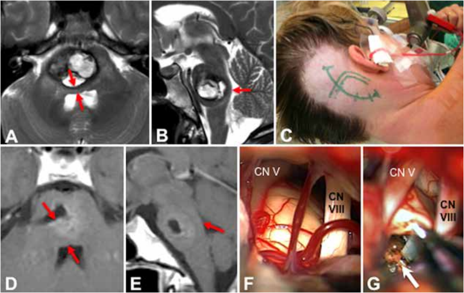 JNS发表德国巴特朗菲教授135例脑干脑桥海绵状血管瘤手术及疗效研究 JNS发表德国巴特朗菲教授135例脑干脑桥海绵状血管瘤手术及疗效研究