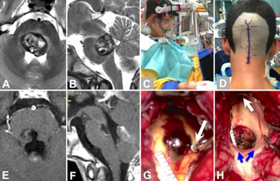 JNS发表德国巴特朗菲教授135例脑干脑桥海绵状血管瘤手术及疗效研究 JNS发表德国巴特朗菲教授135例脑干脑桥海绵状血管瘤手术及疗效研究
