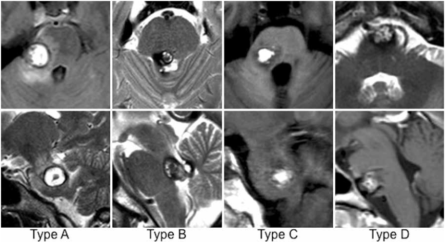 JNS发表德国巴特朗菲教授135例脑干脑桥海绵状血管瘤手术及疗效研究 JNS发表德国巴特朗菲教授135例脑干脑桥海绵状血管瘤手术及疗效研究