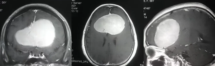 脑瘤从樱桃长成了苹果大、压扁大脑!巨大脑膜瘤还能全切且不伤大脑吗? 脑瘤从樱桃长成了苹果大、压扁大脑!巨大脑膜瘤还能全切且不伤大脑吗?