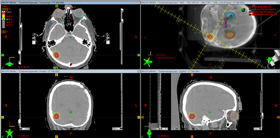 脑瘤从樱桃长成了苹果大、压扁大脑!巨大脑膜瘤还能全切且不伤大脑吗? 脑瘤从樱桃长成了苹果大、压扁大脑!巨大脑膜瘤还能全切且不伤大脑吗?