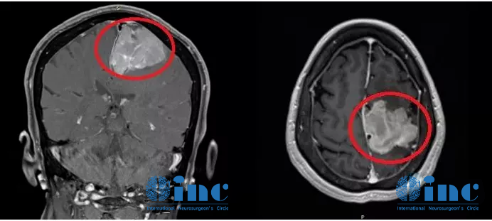 脑瘤从樱桃长成了苹果大、压扁大脑!巨大脑膜瘤还能全切且不伤大脑吗? 脑瘤从樱桃长成了苹果大、压扁大脑!巨大脑膜瘤还能全切且不伤大脑吗?