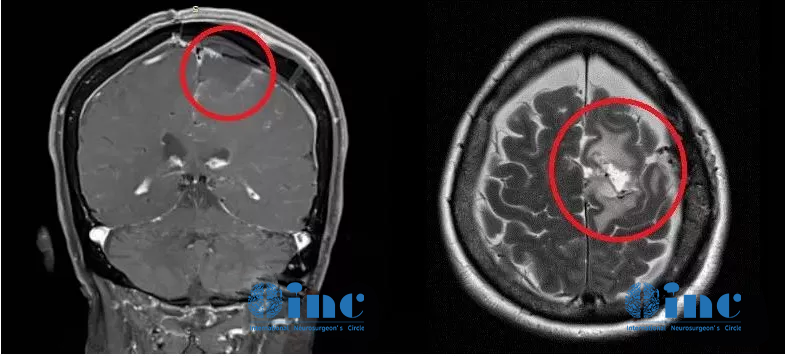 脑瘤从樱桃长成了苹果大、压扁大脑!巨大脑膜瘤还能全切且不伤大脑吗? 脑瘤从樱桃长成了苹果大、压扁大脑!巨大脑膜瘤还能全切且不伤大脑吗?