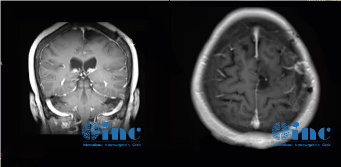 脑瘤从樱桃长成了苹果大、压扁大脑!巨大脑膜瘤还能全切且不伤大脑吗? 脑瘤从樱桃长成了苹果大、压扁大脑!巨大脑膜瘤还能全切且不伤大脑吗?