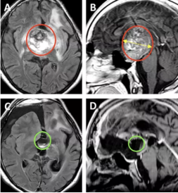 胶质瘤复发和假性进展怎么区别?复发的全方位应对策略 胶质瘤复发和假性进展怎么区别?复发的全方位应对策略
