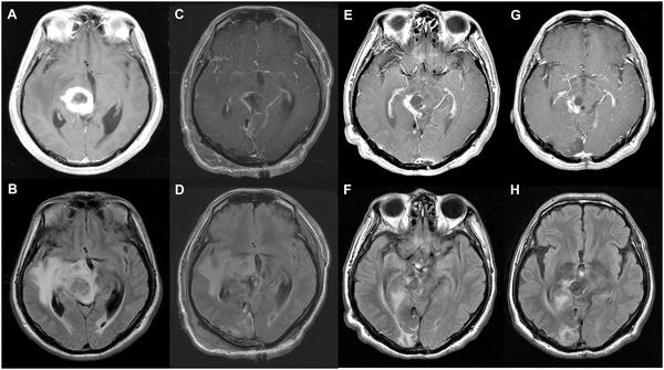 丘脑胶母GBM生存期可有多久?研究显示切除程度越高、生存期越久 丘脑胶母GBM生存期可有多久?研究显示切除程度越高、生存期越久