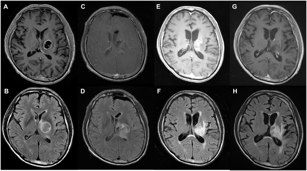 丘脑胶母GBM生存期可有多久?研究显示切除程度越高、生存期越久 丘脑胶母GBM生存期可有多久?研究显示切除程度越高、生存期越久