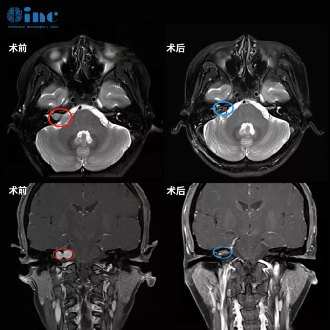听神经瘤手术或不手术都可能面瘫?保面、保听的关键是什么? 听神经瘤手术或不手术都可能面瘫?保面、保听的关键是什么?