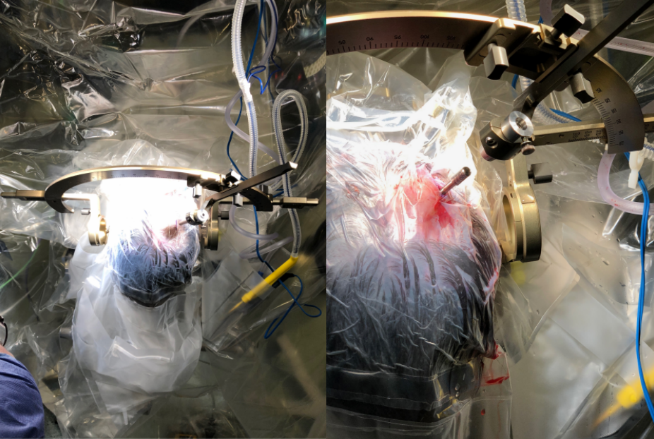 激光间质热疗LITT在儿童脑瘤、癫痫综述及INC加拿大Rutka教授成功案例 激光间质热疗LITT在儿童脑瘤、癫痫综述及INC加拿大Rutka教授成功案例