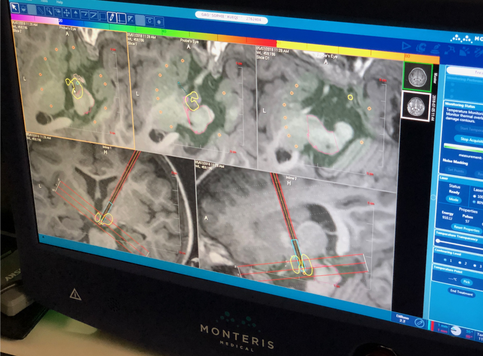 激光间质热疗LITT在儿童脑瘤、癫痫综述及INC加拿大Rutka教授成功案例 激光间质热疗LITT在儿童脑瘤、癫痫综述及INC加拿大Rutka教授成功案例