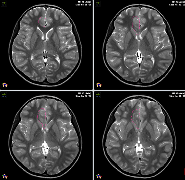 激光间质热疗LITT在儿童脑瘤、癫痫综述及INC加拿大Rutka教授成功案例 激光间质热疗LITT在儿童脑瘤、癫痫综述及INC加拿大Rutka教授成功案例