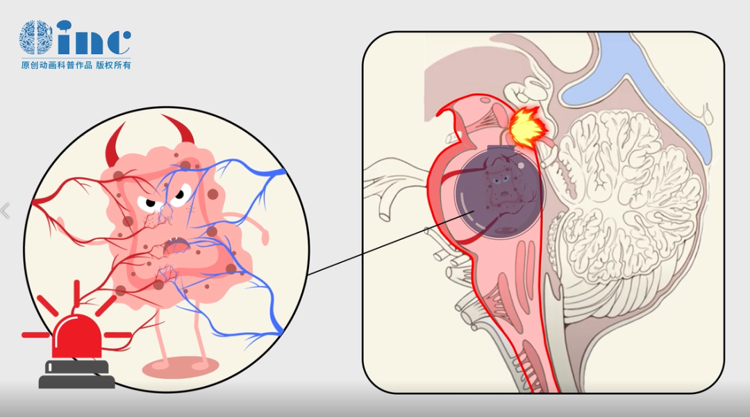 孕妈瘫痪,竟是脑干肿瘤出血作祟,脑干手术后诞下婴孩造“医学奇迹” 孕妈瘫痪,竟是脑干肿瘤出血作祟,脑干手术后诞下婴孩造“医学奇迹”