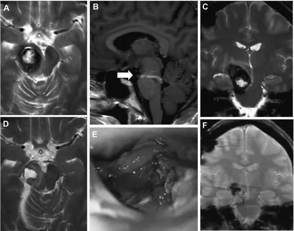 孕妈瘫痪,竟是脑干肿瘤出血作祟,脑干手术后诞下婴孩造“医学奇迹” 孕妈瘫痪,竟是脑干肿瘤出血作祟,脑干手术后诞下婴孩造“医学奇迹”