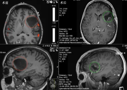 岛叶胶质瘤能安全全切吗?INC国际教授手术案例分享及治疗解读 岛叶胶质瘤能安全全切吗?INC国际教授手术案例分享及治疗解读