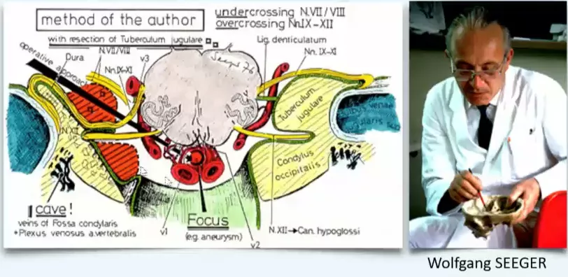 走路乏力、脖子痛,被“颈椎病”耽误的枕骨大孔脑膜瘤 走路乏力、脖子痛,被“颈椎病”耽误的枕骨大孔脑膜瘤