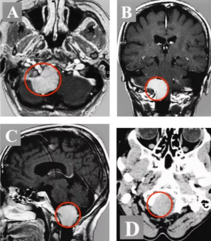走路乏力、脖子痛,被“颈椎病”耽误的枕骨大孔脑膜瘤 走路乏力、脖子痛,被“颈椎病”耽误的枕骨大孔脑膜瘤