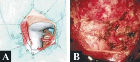 走路乏力、脖子痛,被“颈椎病”耽误的枕骨大孔脑膜瘤 走路乏力、脖子痛,被“颈椎病”耽误的枕骨大孔脑膜瘤