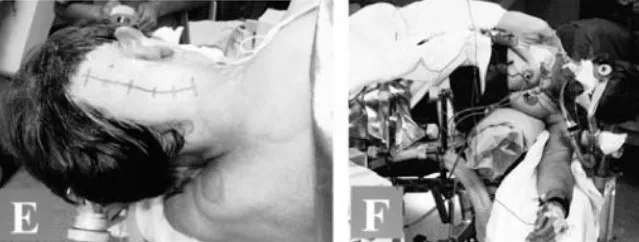 走路乏力、脖子痛,被“颈椎病”耽误的枕骨大孔脑膜瘤 走路乏力、脖子痛,被“颈椎病”耽误的枕骨大孔脑膜瘤