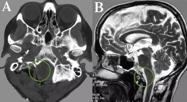 走路乏力、脖子痛,被“颈椎病”耽误的枕骨大孔脑膜瘤 走路乏力、脖子痛,被“颈椎病”耽误的枕骨大孔脑膜瘤