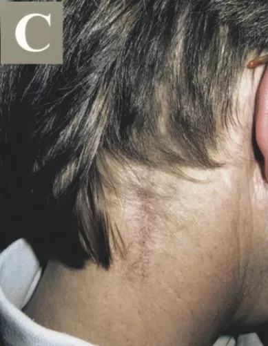 走路乏力、脖子痛,被“颈椎病”耽误的枕骨大孔脑膜瘤 走路乏力、脖子痛,被“颈椎病”耽误的枕骨大孔脑膜瘤